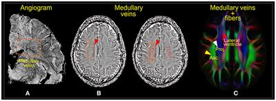 Altered Glymphatic System in Middle-Aged cART-Treated Patients With HIV: A Diffusion Tensor Imaging Study